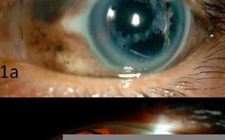 ophthalmia什么意思,ophthalmia中文翻译,ophthalmia用法及例句,ophthalmia怎么读