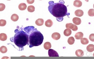 leukemia什么意思,leukemia中文翻译,leukemia用法及例句,leukemia怎么读