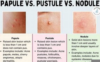 nodule什么意思,nodule中文翻译,nodule用法及例句,nodule怎么读