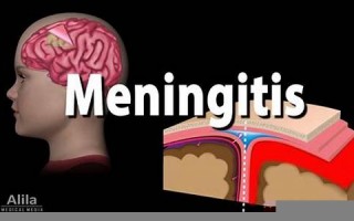 meningitis什么意思,meningitis中文翻译,meningitis用法及例句,meningitis怎么读