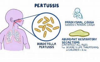 pertussis什么意思,pertussis中文翻译,pertussis用法及例句,pertussis怎么读